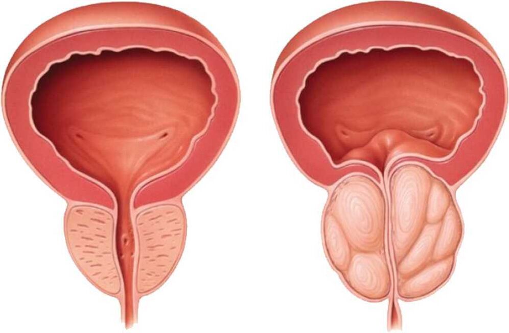 prostata dolorante